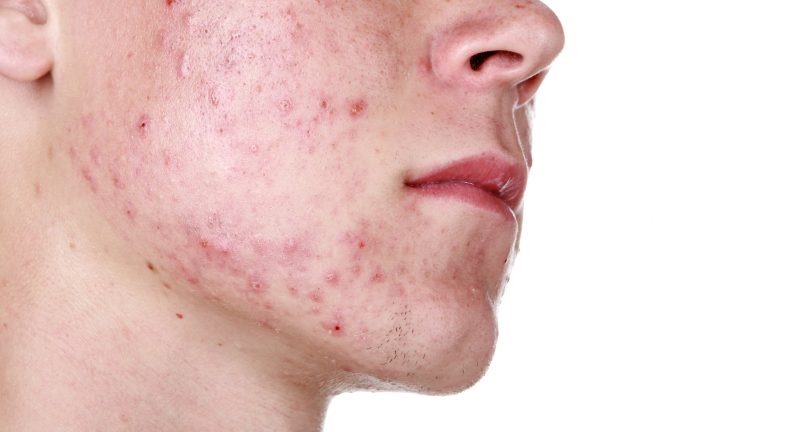 Подкожный клещ на лице и теле – как выглядит, как избавиться от демодекса? Симптомы и лечение демодекоза у человека