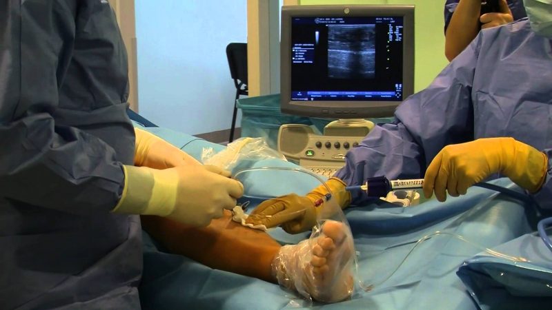Радиочастотная абляция сердца: как проводится, показания к операции РЧА, возможные осложнения