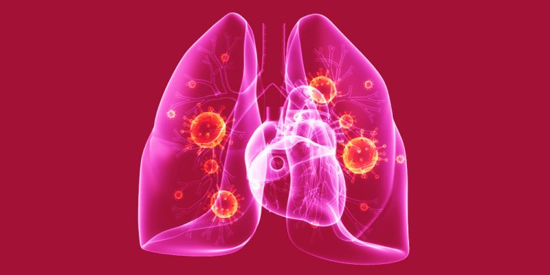 Вирусная пневмония: причины, симптомы и лечение заболевания у взрослых и детей