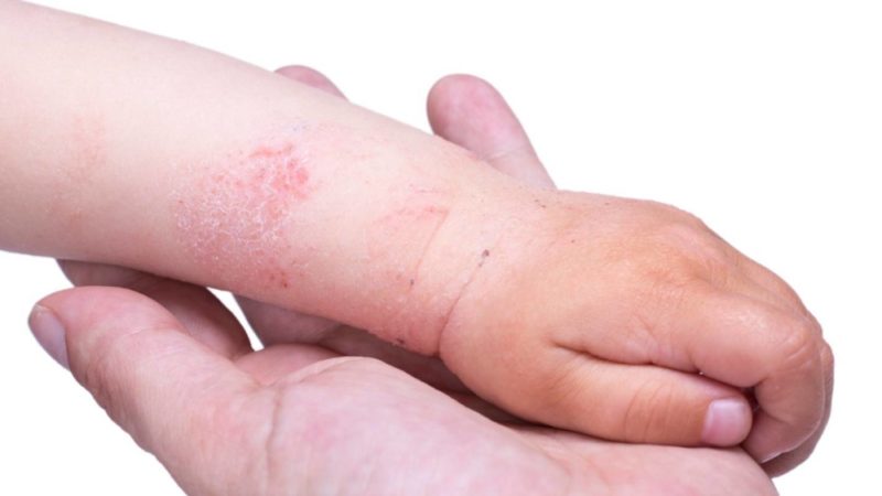 Аллергическая крапивница: лечение, симптомы у детей и взрослых, диета, причины возникновения
