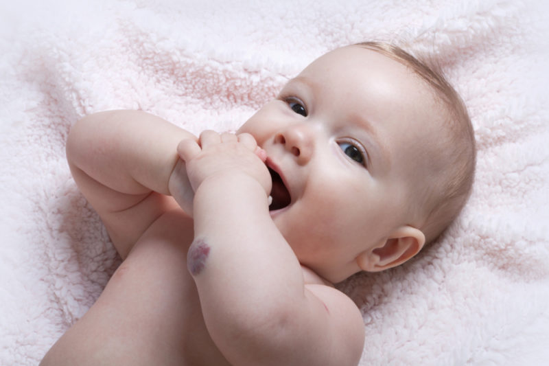 Гемангиома у новорожденных: причины возникновения, опасна ли, лечение опухоли