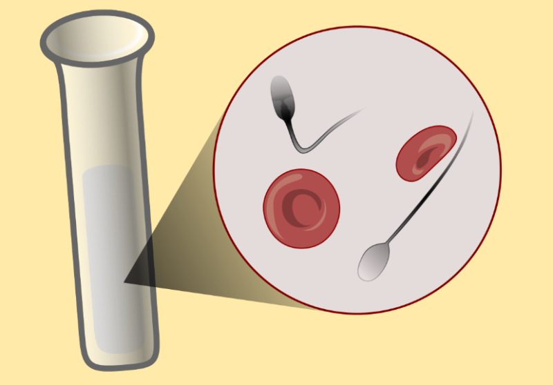 Кровь в сперме (гемоспермия): причины и лечение патологии