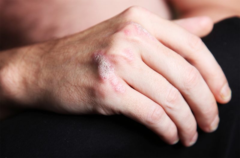 Псориаз на руках: симптомы и лечение чешуйчатого лишая